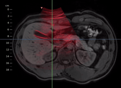 ../../_images/US.UltrasoundRegistrationTutorial.analysis03.gif