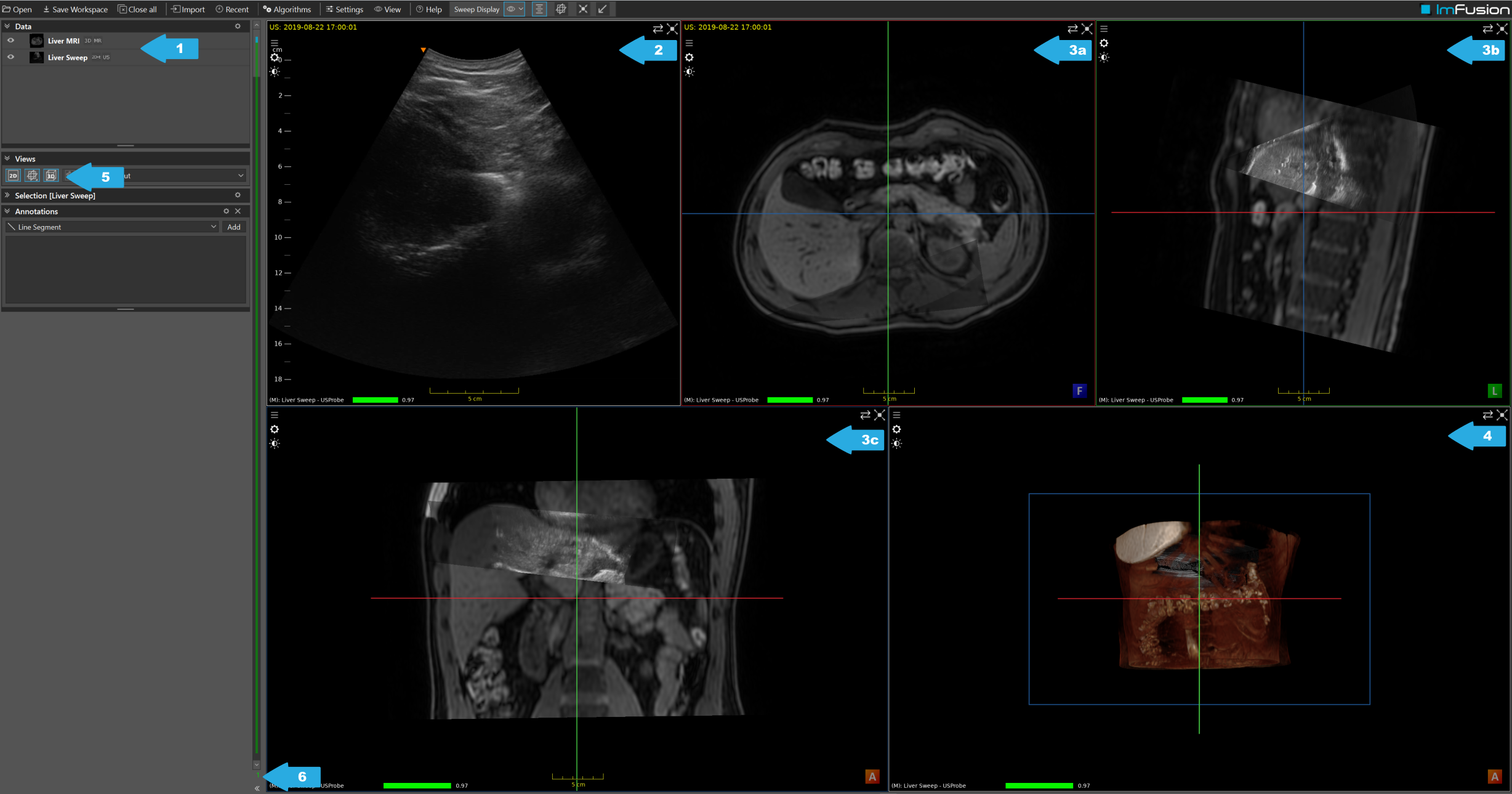 ../../_images/US.UltrasoundRegistrationTutorial.exploration00.png